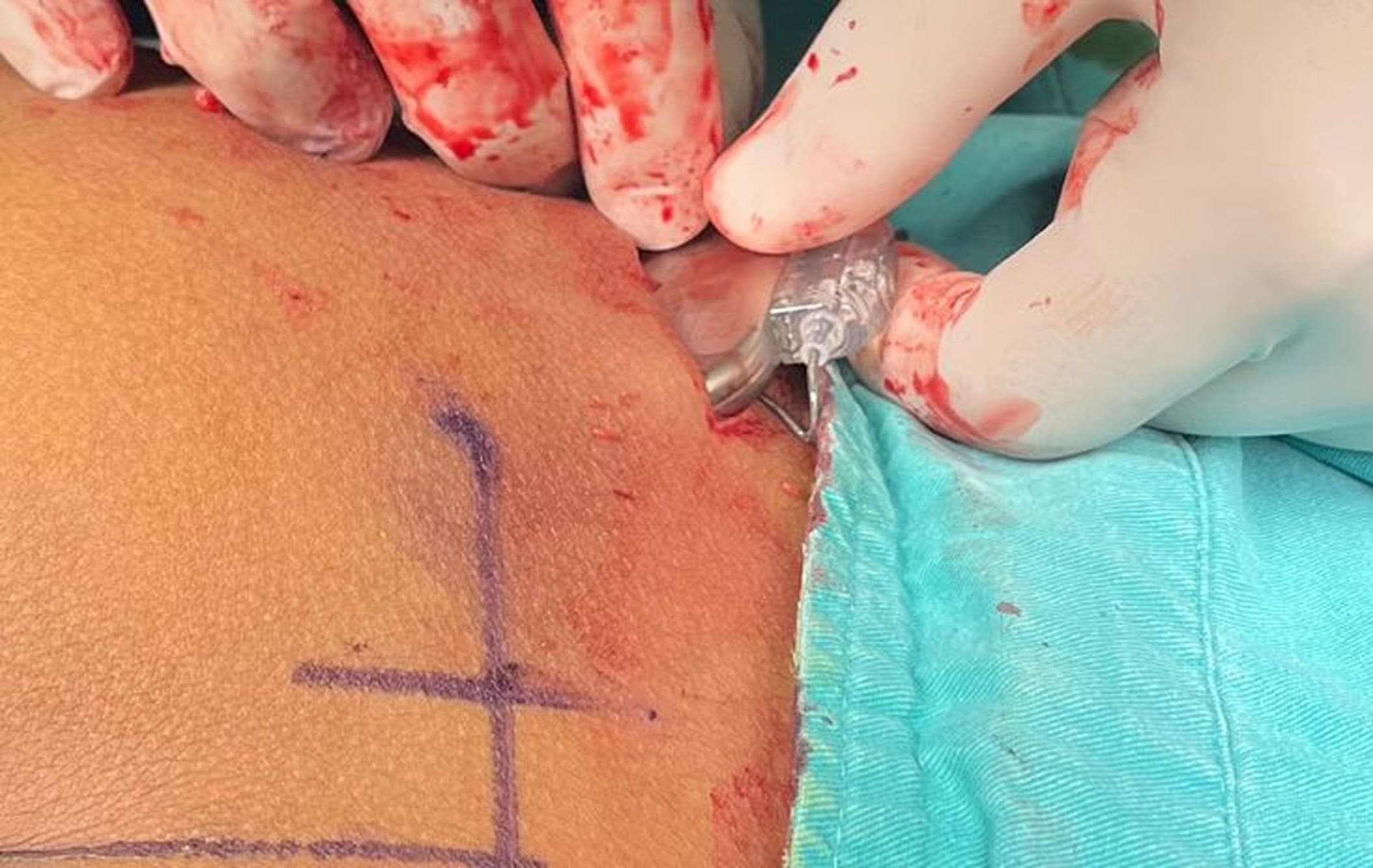 Preoperative surgical marking before gynecological procedure